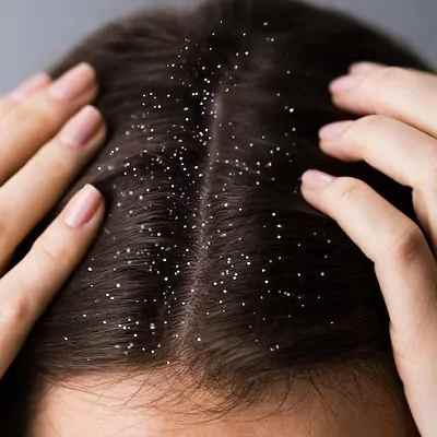 أستاذ جلدية يكشف أنواع قشرة الشعر والعلاج النهائي في وقت قصير