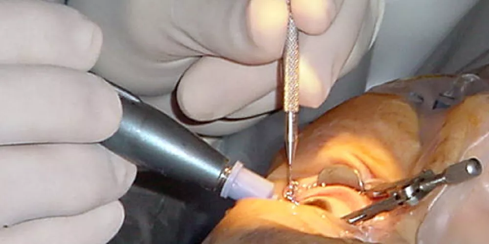 جراحة دقيقة بمستشفى رمد بني سويف تُعيد البصر لمريض بعد فقدانه 15 عامًا