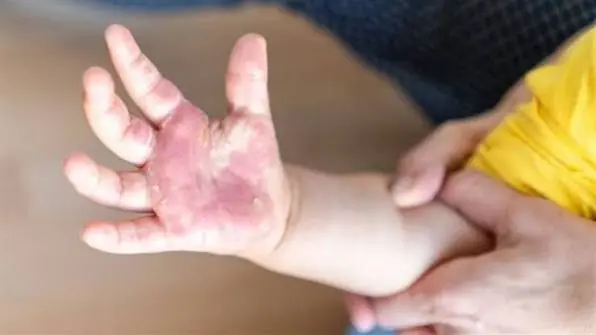 180 ألف وفاة سنويًا بسبب الحروق.. وزارة الصحة تكشف طرق الوقاية والإسعافات الأولية الصحيحة