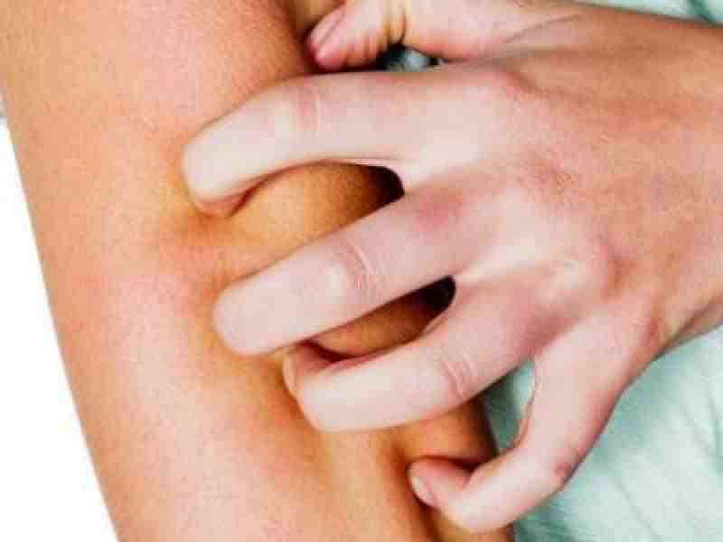 عصام فرج يكشف سبب «الشكشكة» والهرش المستمر ويعلن العلاج الفعّال خلال 3 أيام